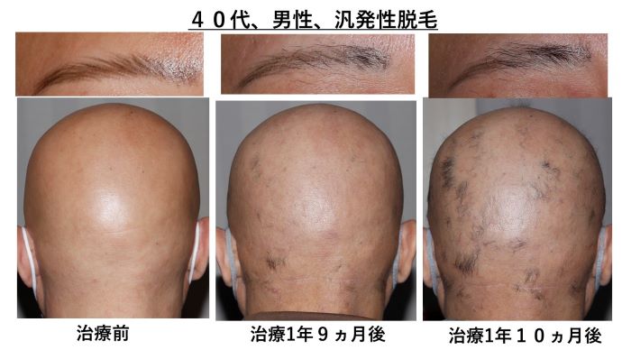 円形脱毛症　病院